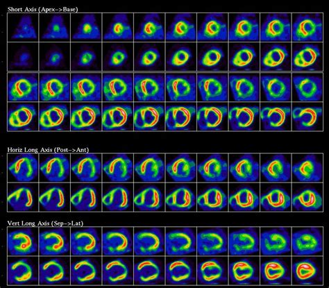how to read pet scan results|Positron emission tomography scan .